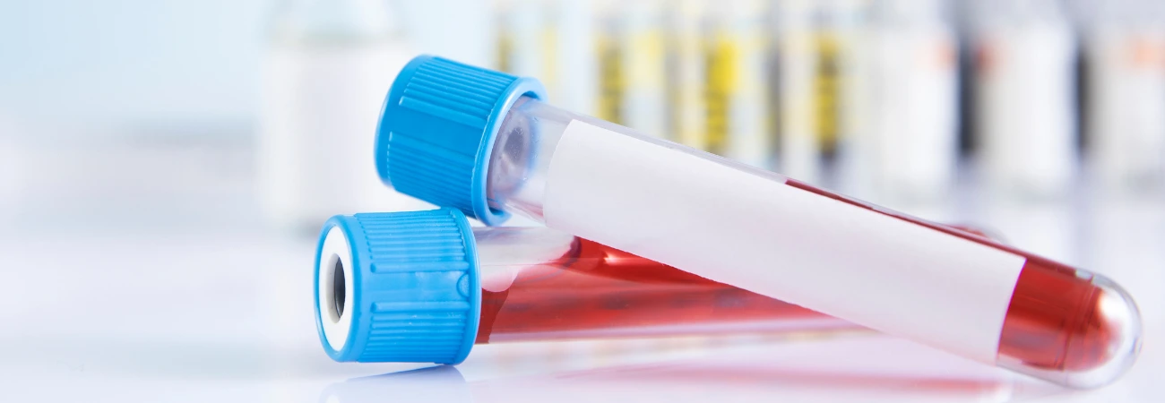 Neuer Bluttest zeigt Ausmaß der Hirnschädigung nach Schlaganfall