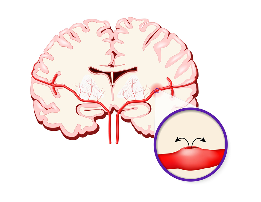 Eine Hirnblutung wird durch ein geplatztes Gefäß verursacht.