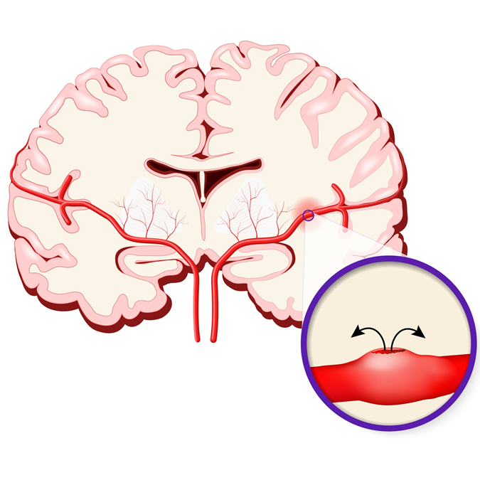 Hirnblutung - wenn ein Gefäß platzt