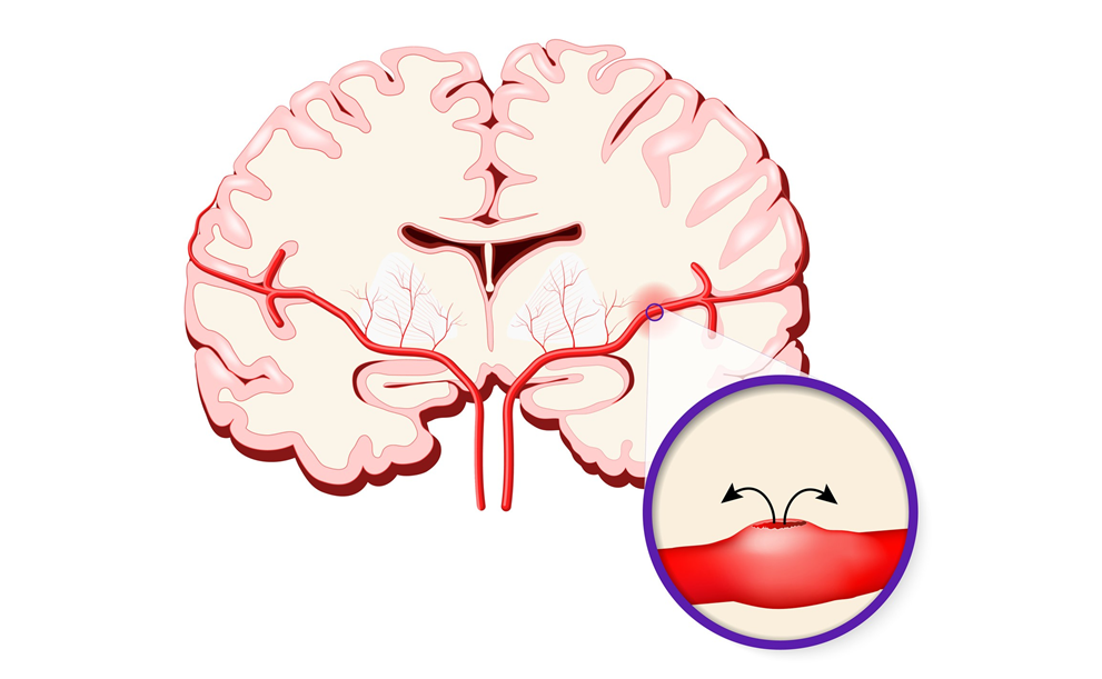 Hirnblutung ist eine Ursache vom Schlaganfall