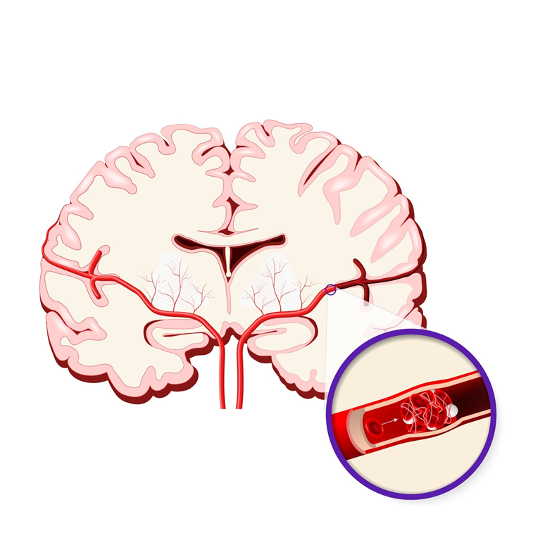 Mehr zum Hirninfarkt